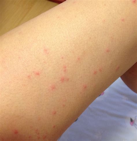 Scabies Skin Rash Images