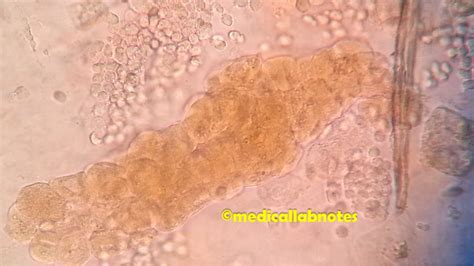 Urine Casts: Introduction, Identification Features, and Clinical ...