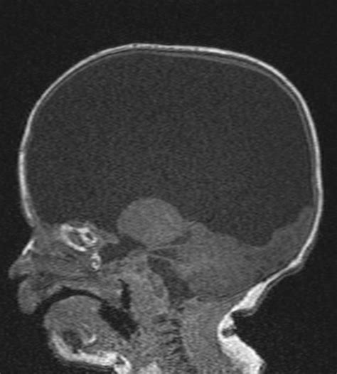 Hydranencephaly | Radiology Case | Radiopaedia.org | Brain images ...