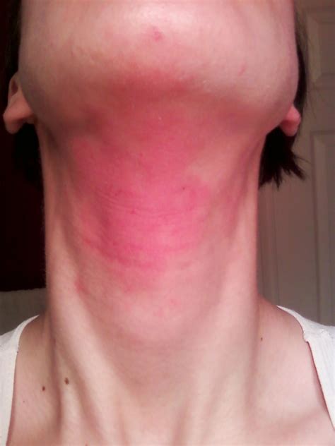 Allergic Reaction to Beeswax? | eczemaexcellence