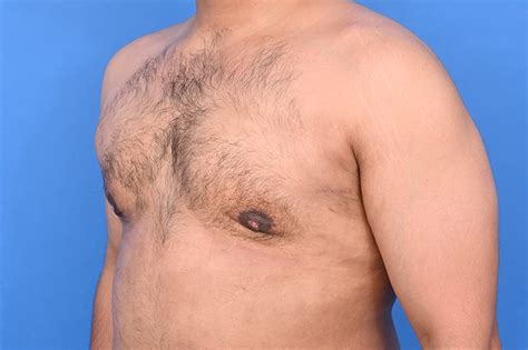 Gynecomastia Surgery Before & After Patient 22017 | AGC