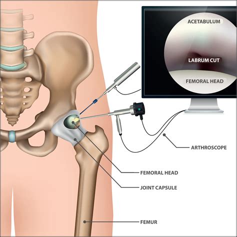 Hip Arthroscopy Information | Florida Orthopaedic Institute