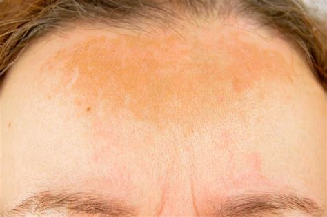 How to Get Rid of Sunspots on Your Face | Siti Med Spa