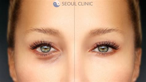 Lower Eyelid Surgery In Korea: Cost, Clinics, And More, 2024