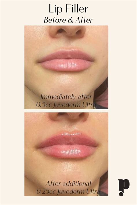 Before and After of lip injections/filler with .75 cc of Juvederm Ultra. 1st photo is after .5 ...