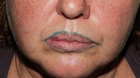 Lip Tattoo Gone Wrong: One Woman's Permanent Green Lip Liner Nightmare