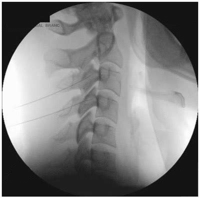 Cervical Facet Medial Branch Block | Global Pain Care