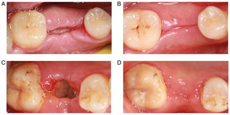 Dental Surgery How Long To Heal at Jacqualine Barney blog