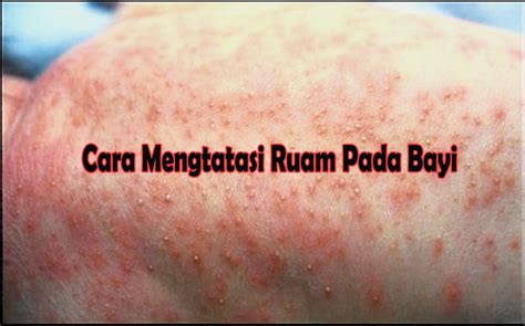 Cara Mengatasi Ruam Pada Kulit Bayi | Sang Hamba