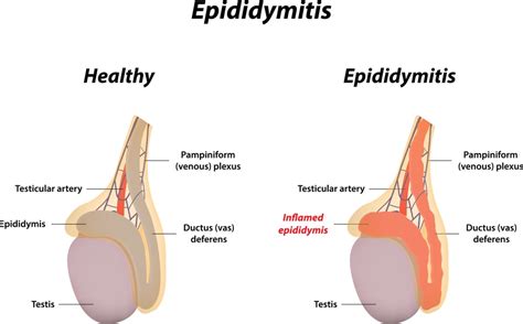 Dealing with an Epididymal Cyst - Facty Health