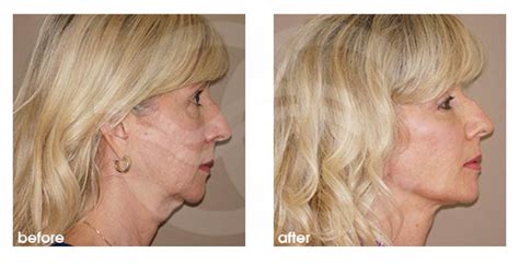 Plastic and Cosmetic Surgery: Get Rid of Your Turkey Neck Before Christmas!