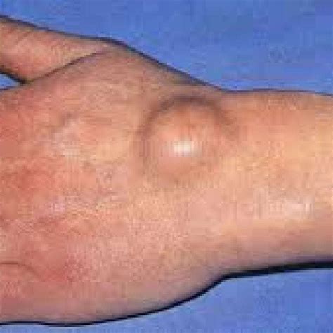 Hygroma: what is it, causes, symptoms and treatment