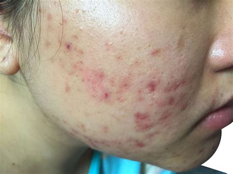 Diseases That Cause Acne