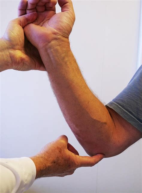 Ulnar Nerve Entrapment at the Elbow (Cubital Tunnel Syndrome) - OrthoInfo - AAOS