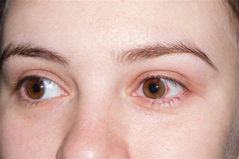 Keratomalacia Definition: Understanding the Corneal Condition – sightconnection