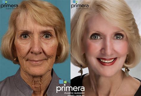 Chemical Peel Before and After Pictures Case 81 | Orlando, Florida | Primera Plastic Surgery ...