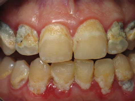 Diseases: Gum Disease Treatment