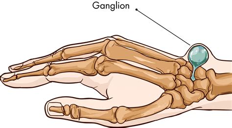 Ganglion Cysts Surgery and Treatment in Montreal