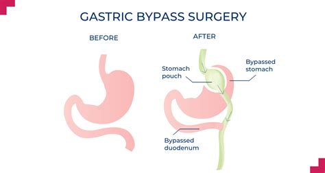 Roux-en-Y Gastric Bypass Perth | Weight Loss Surgery