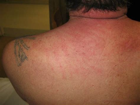 Dermatomyositis Skin Rash