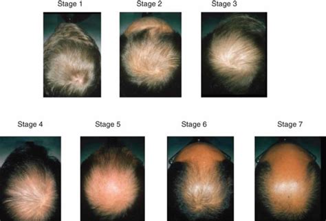 Male or female pattern baldness causes and baldness treament