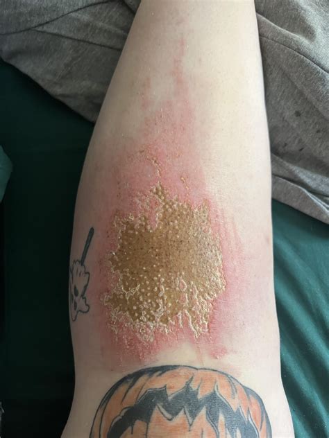 Road rash healing process : r/woundcare