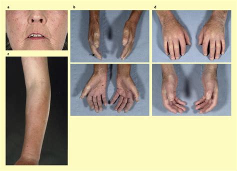 Systemic sclerosis: clinical features and management - Medicine