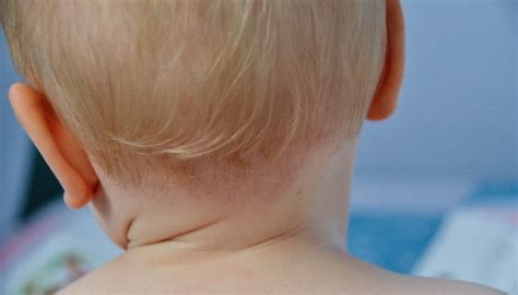 Birthmark Types; Moles, Macular Stains, Port-Wine Stains and More - Health & Wellness Blog ...