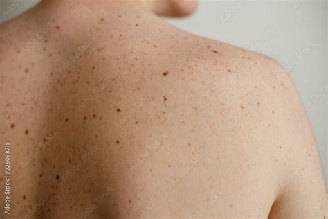 Close up detail of the bare skin on a man back with scattered moles and ...