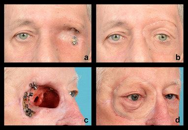 Ocular Prosthetic