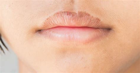 Six ways to treat chapped lips - Say Tik