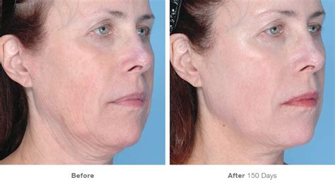 Ultherapy Before And After Pics