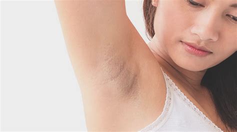 Get Rid of Dark Underarms and Chicken Skin | Belo Medical Group