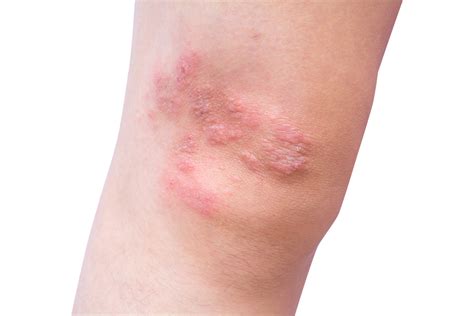 What Causes Dermatitis Herpetiformis? - Redorbit