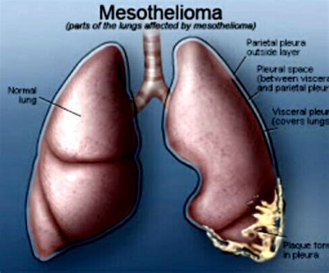 Information About Mesothelioma Cancer | Health News