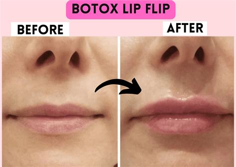 Botox Lip Flip Side Effects - the daily glimmer