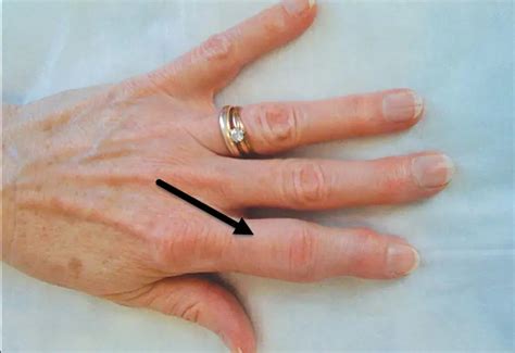 Arthritis Bumps On Knuckles