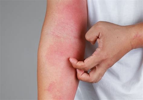 What Are the Symptoms of Allergic Contact Dermatitis?