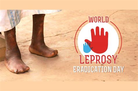 Reduce stigma against leprosy on world leprosy day