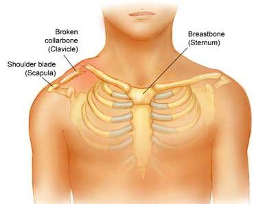 Clavicle Fracture | Shoulder Doctor