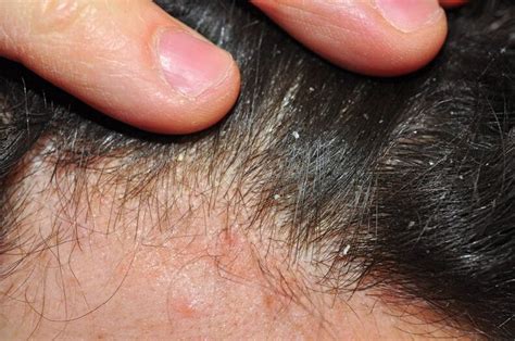 Psoriasis on the head: how it looks on the skin and scalp, treatment ...