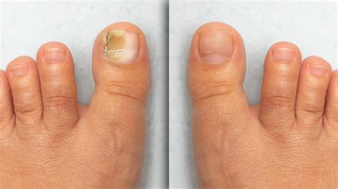 Nail Conditions | NY | Hudson Dermatology