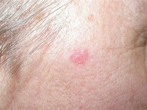 Basal Cell Carcinoma Types