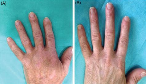 Epidermal skin grafting in vitiligo: a pilot study - Janowska - 2016 ...