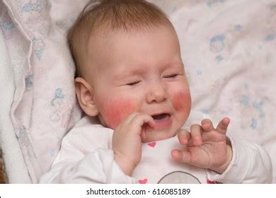 Best Eczema Eye Royalty-Free Images, Stock Photos & Pictures | Shutterstock