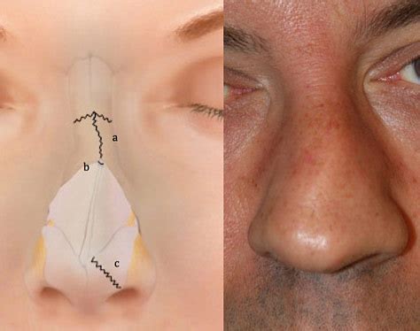 Nasal Fractures, Septal Hematoma, and Septal Perforation