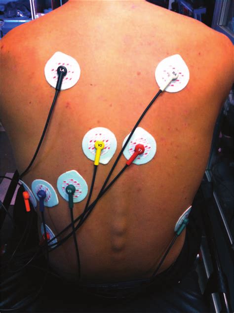 15 lead ecg placement posterior - lineartdrawingsbrowncolor