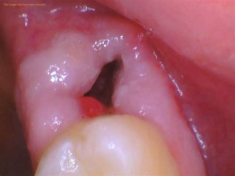 Black Stuff Coming Out of My Wisdom Tooth Hole - 1311 Jackson Ave Dental | Dentist in Long ...