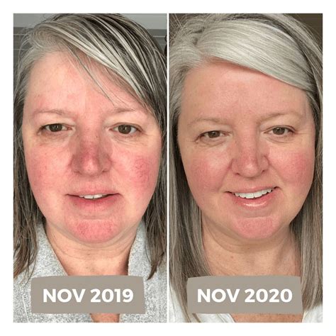 My Experience with Laser Treatment for Rosacea including Before & After Photos in 2021 | Laser ...