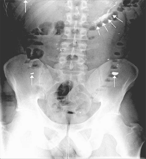 Radiographie abdominale du patient à J0. Flèches : opacités... | Download Scientific Diagram